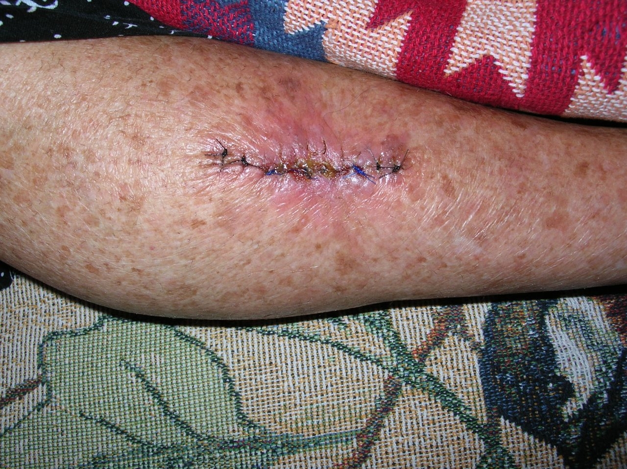 Wife's latest basal cell removal